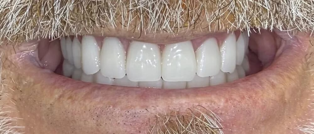 Dentaduras Después