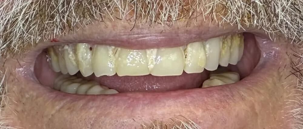 Dentaduras Antes