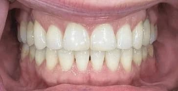 Invisalign, blanqueamiento y bonding Después