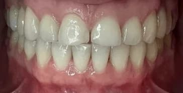 Invisalign, blanqueamiento y bonding Antes
