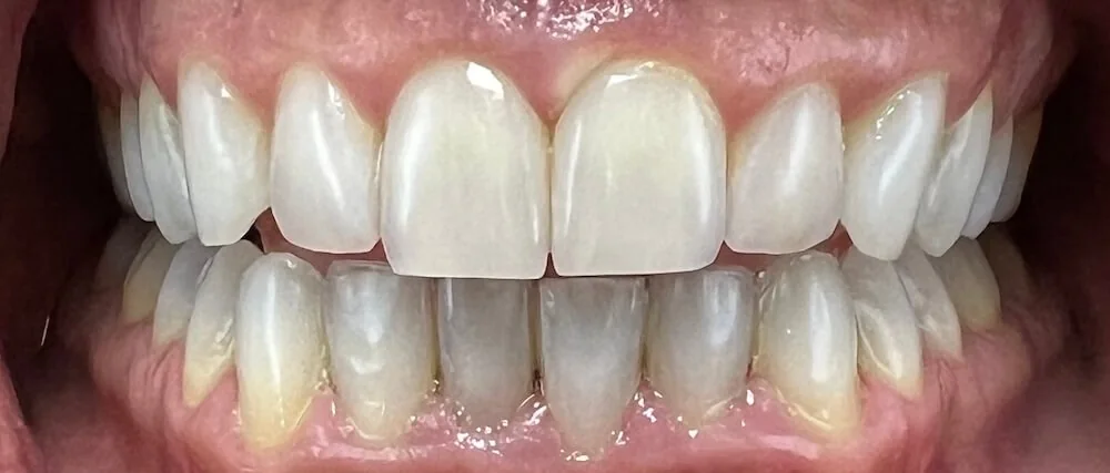Blanqueamiento dental Después