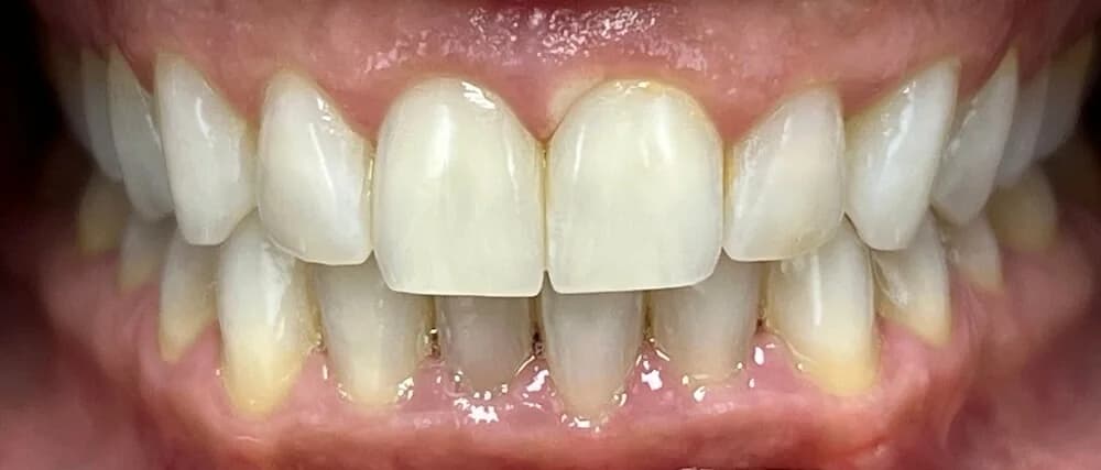 Blanqueamiento dental Antes