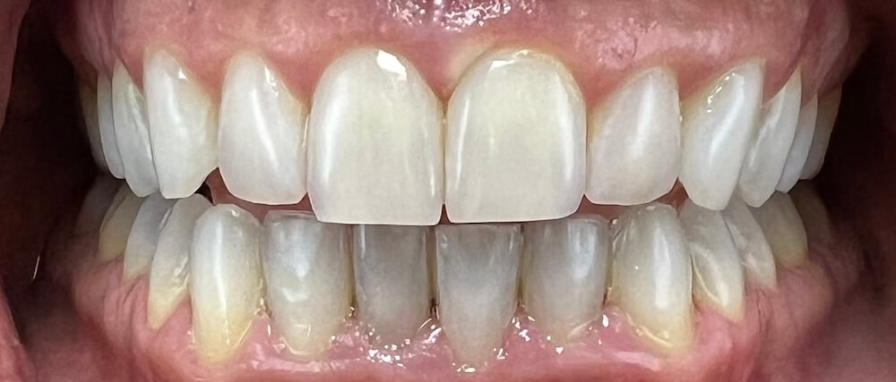 Teeth Whitening After