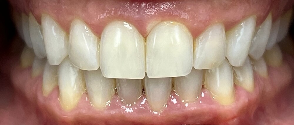 Teeth Whitening Before