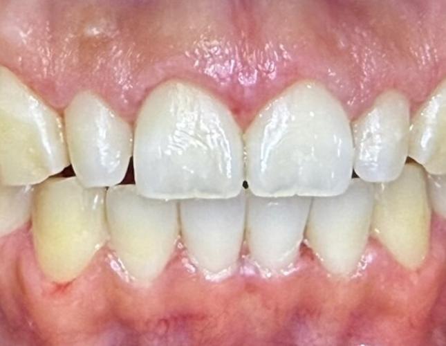 Gum Contouring After