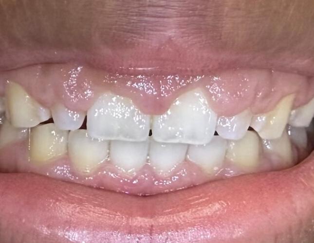 Gum Contouring Before