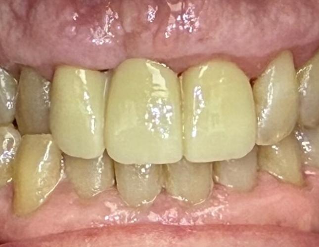 Smile Makeover After