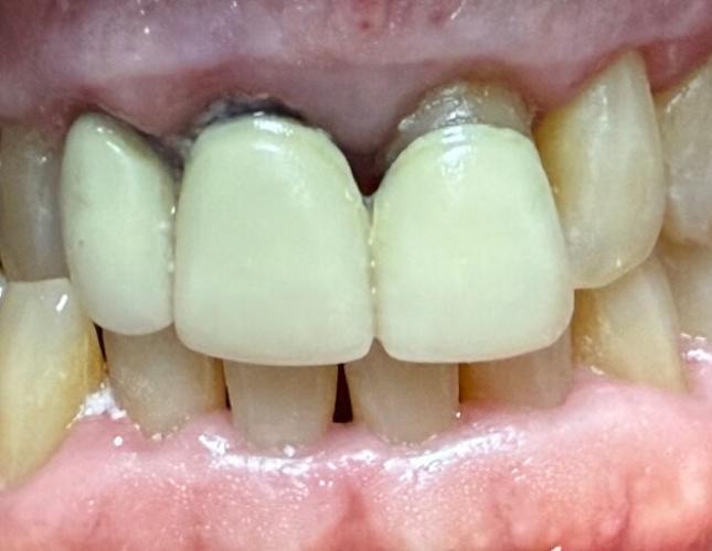 Smile Makeover Before