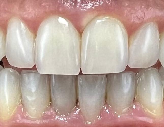 Teeth Whitening After