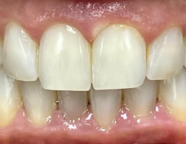 Teeth Whitening Before